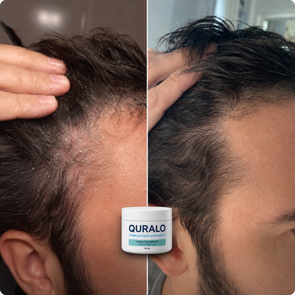 QURALO| Crema contra la caspa y dermatitis seborreica