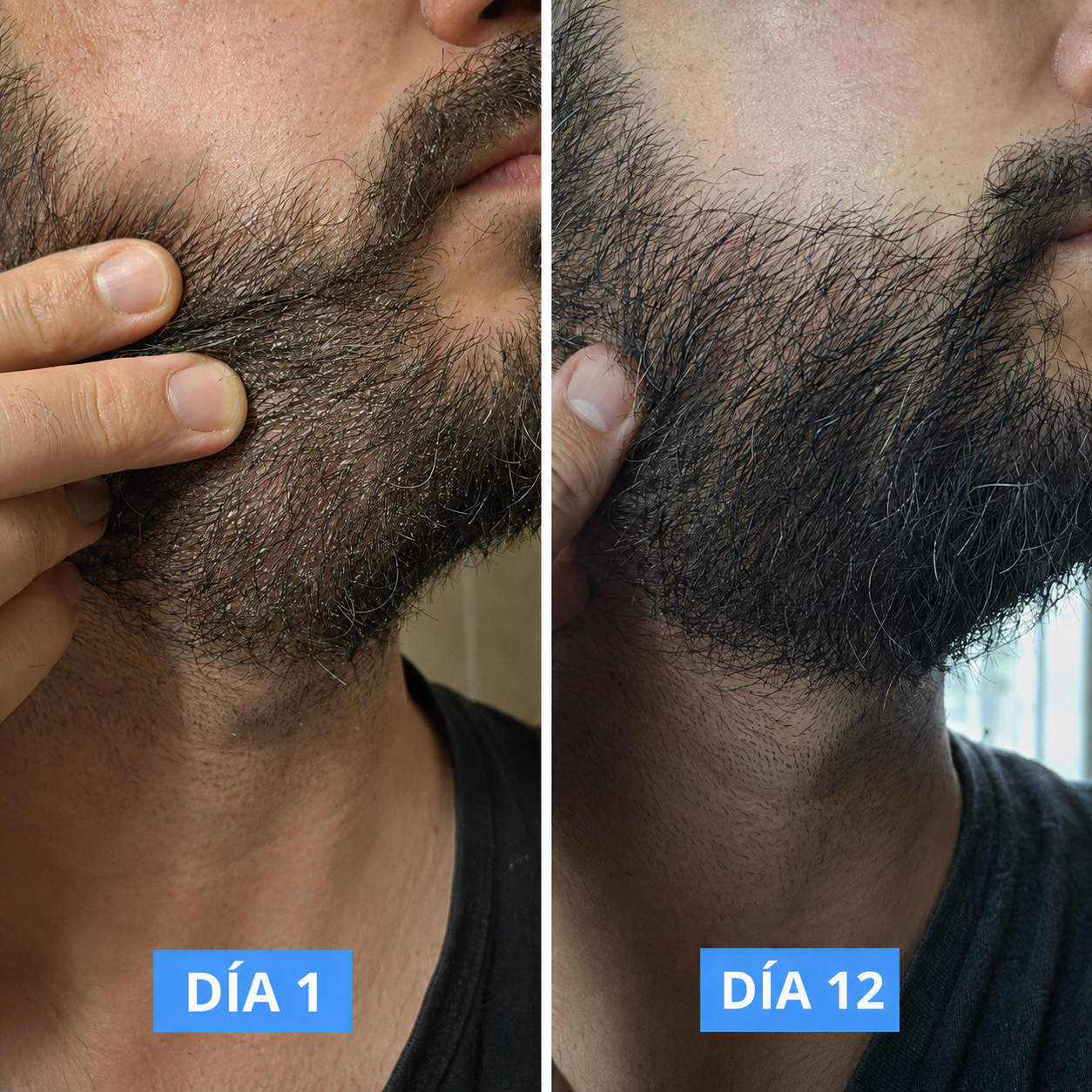QURALO| Crema contra la caspa y dermatitis seborreica